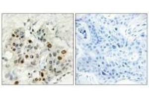 Immunohistochemistry analysis of paraffin-embedded human breast carcinoma tissue, using AF4 antibody. (AF4 抗体  (N-Term))