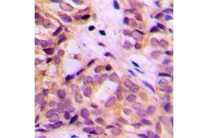 Immunohistochemical analysis of ALDH1A2 staining in human breast cancer formalin fixed paraffin embedded tissue section. (ALDH1A2 抗体  (C-Term))
