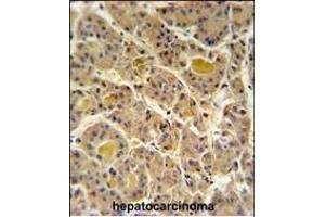IN80D Antibody (N-term) (ABIN651234 and ABIN2840146) IHC analysis in formalin fixed and paraffin embedded human hepatocarcinoma followed by peroxidase conjugation of the secondary antibody and DAB staining. (IN80D 抗体  (N-Term))