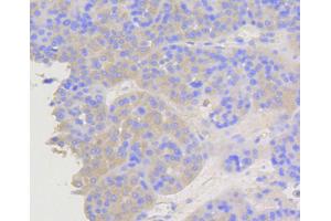 Immunohistochemistry of paraffin-embedded human liver cancer using ARRB1 antibody (ABIN5996907) at dilution of 1/100 (40x lens). (beta Arrestin 1 抗体)