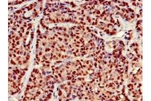 Immunohistochemistry of paraffin-embedded human ovarian cancer using ABIN7164525 at dilution of 1:100