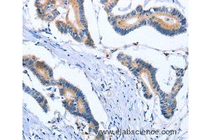 Immunohistochemistry of Human colon cancer using PLK3 Polyclonal Antibody at dilution of 1:30 (PLK3 抗体)