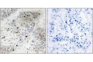 Immunohistochemistry analysis of paraffin-embedded human breast carcinoma, using p53 (Phospho-Ser9) Antibody. (p53 抗体  (pSer9))