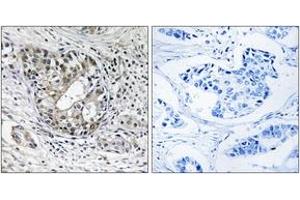 Immunohistochemistry analysis of paraffin-embedded human breast carcinoma tissue, using PNPT1 Antibody. (PNPT1 抗体  (AA 570-619))