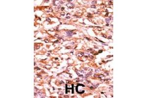Formalin-fixed and paraffin-embedded human hepatocellular carcinoma tissue reacted with CDC25B (phospho S187) polyclonal antibody  which was peroxidase-conjugated to the secondary antibody followed by AEC staining. (CDC25B 抗体  (pSer187))