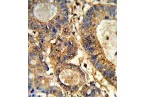 Immunohistochemistry analysis in formalin-fixed and paraffin-embedded human colon carcinoma reacted with Beta-glucuronidase Antibody (Center) followed which was peroxidase-conjugated to the secondary antibody, followed by DAB staining. (Glucuronidase beta 抗体  (Middle Region))