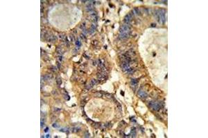 Immunohistochemistry analysis in formalin-fixed and paraffin-embedded human colon carcinoma reacted with Beta-glucuronidase Antibody (Center) followed which was peroxidase-conjugated to the secondary antibody, followed by DAB staining.