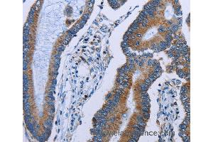 Immunohistochemistry of Human colon cancer using IDH2 Polyclonal Antibody at dilution of 1:60 (IDH2 抗体)