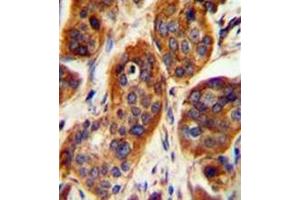Immunohistochemistry analysis in formalin fixed and paraffin embedded human bladder carcinoma reacted with LRRC57 Antibody (C-term) followed which was peroxidase conjugated to the secondary antibody and followed by DAB staining. (LRRC57 抗体  (C-Term))