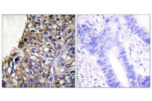 Immunohistochemical analysis of paraffin-embedded human lung carcinoma tissue using Claudin 7 antibody (ABIN5976363). (Claudin 7 抗体  (C-Term))