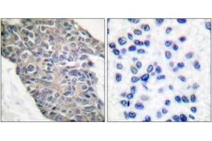 Immunohistochemistry analysis of paraffin-embedded human breast carcinoma tissue, using Synaptotagmin (Ab-202) Antibody. (Synaptotagmin 抗体  (AA 176-225))