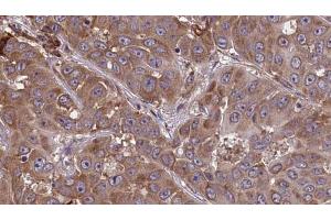 ABIN6273449 at 1/100 staining Human liver cancer tissue by IHC-P. (CD48 抗体  (Internal Region))
