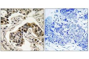 Immunohistochemistry analysis of paraffin-embedded human breast carcinoma tissue using NudC (Phospho-Ser326) antibody. (NUDC 抗体  (pSer326))