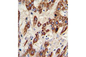 Formalin-fixed and paraffin-embedded human hepatocarcinoma reacted with MMP3 Antibody , which was peroxidase-conjugated to the secondary antibody, followed by DAB staining. (MMP3 抗体  (AA 298-327))