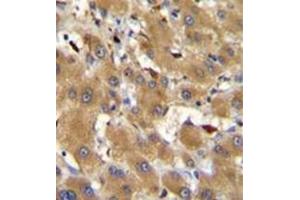 Immunohistochemistry analysis in formalin fixed and paraffin embedded human hepatocarcinoma reacted with HPR Antibody (Center) followed by peroxidase conjugation of the secondary antibody and DAB staining. (HPR 抗体  (Middle Region))