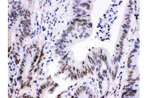 Anti- Cdk9 Picoband antibody, IHC(P) IHC(P): Human Intestinal Cancer Tissue (CDK9 抗体  (AA 141-372))