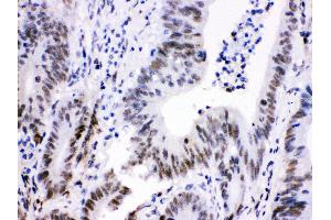 Anti- Cdk9 Picoband antibody, IHC(P) IHC(P): Human Intestinal Cancer Tissue