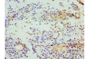 Immunohistochemistry of paraffin-embedded human breast cancer using ABIN7152008 at dilution of 1:100