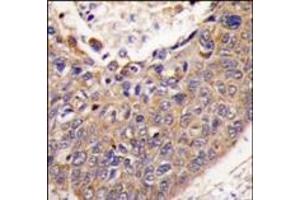 Formalin-fixed and paraffin-embedded human lung carcinoma tissue reacted with FXN antibody (C-term), which was peroxidase-conjugated to the secondary antibody, followed by DAB staining. (Frataxin 抗体  (C-Term))