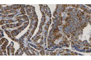ABIN6267188 at 1/100 staining Human thyroid cancer tissue by IHC-P. (SYK 抗体  (pSer297))