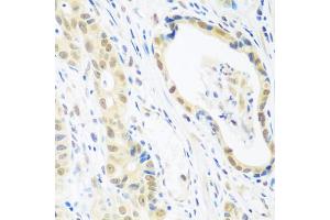 Immunohistochemistry of paraffin-embedded human stomach cancer using POLR2E antibody. (POLR2E 抗体)