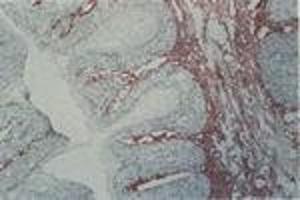 Carcinoma in situ, vulva (MAb EB2, tenascin) (TNC 抗体)