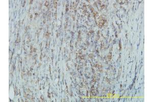 Immunoperoxidase of monoclonal antibody to TYK2 on formalin-fixed paraffin-embedded human lymphoma. (TYK2 抗体  (AA 276-375))