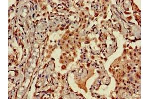 Immunohistochemistry of paraffin-embedded human lung cancer using ABIN7161610 at dilution of 1:100 (NINJ1 抗体  (AA 1-80))