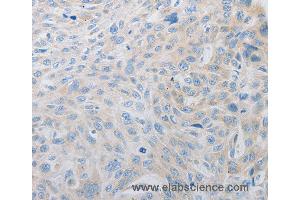 Immunohistochemistry of Human esophagus cancer using PDX1 Polyclonal Antibody at dilution of 1:30 (PDX1 抗体)