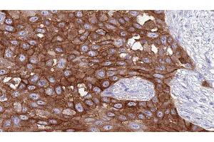 ABIN6277050 at 1/100 staining Human Head and neck cancer tissue by IHC-P. (CD247 抗体  (C-Term))