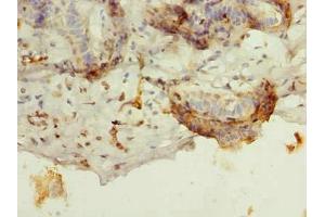 Immunohistochemistry of paraffin-embedded human breast cancer using ABIN7145275 at dilution of 1:100 (BATF 抗体  (AA 1-125))