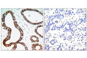 Immunohistochemical analysis of paraffin-embedded human breast carcinoma tissue, using 14-3-3 ζ (Ab-58) antibody (E021188). (14-3-3 zeta 抗体)