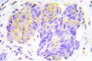 Immunohistochemistry (IHC) analyzes of p-4E-BP1 antibody in paraffin-embedded human lung adenocarcinoma tissue. (eIF4EBP1 抗体  (pThr45))