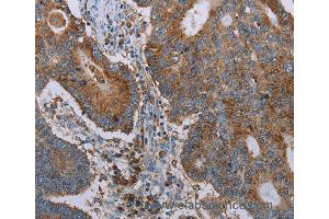 Immunohistochemistry of Human thyroid cancer using CYP7A1 Polyclonal Antibody at dilution of 1:20 (CYP7A1 抗体)
