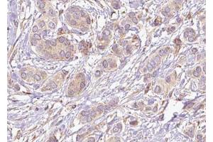 ABIN6274661 at 1/100 staining Human breast cancer tissue by IHC-P.