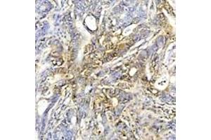Immunohistochemistry analysis of human colon cancer tissue using HSP70 mAb (C92F3A-5) at a dilution of 1:50. (HSP70 抗体)