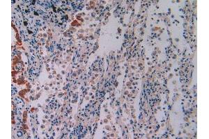 IHC-P analysis of Human Lung Cancer Tissue, with DAB staining. (IFI16 抗体  (AA 465-671))