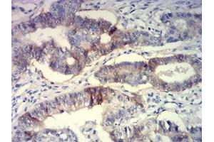 Immunohistochemical analysis of paraffin-embedded lung cancer tissues using CD239 mouse mAb with DAB staining. (BCAM 抗体  (AA 32-197))