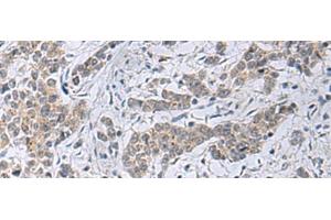 Immunohistochemistry of paraffin-embedded Human colorectal cancer tissue using SLC4A3 Polyclonal Antibody at dilution of 1:35(x200) (SLC4A3 抗体)