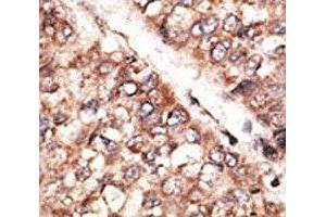 IHC analysis of FFPE human hepatocarcinoma tissue stained with the BMP3 antibody (BMP3 抗体  (AA 8-36))