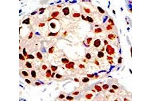 IHC analysis of FFPE human breast carcinoma tissue stained with the PRMT1 antibody (PRMT1 抗体  (AA 316-347))