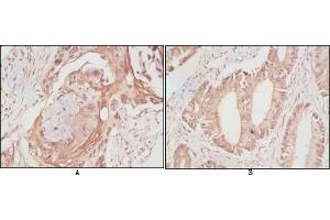 Immunohistochemical analysis of paraffin-embedded human lung cancer (A) and rectal cancer (B), showing cytoplasmic localization using DDX4 mouse mAb with DAB staining. (DDX4 抗体)