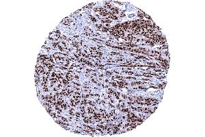 Invasive breast cancer of no special type NST with strong PR immunostaining in 100 of tumor cells (Recombinant Progesterone Receptor 抗体  (AA 1-200))