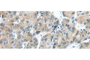 Immunohistochemistry of paraffin-embedded Human liver cancer using TXNDC5 Polyclonal Antibody at dilution of 1/40 (TXNDC5 抗体)