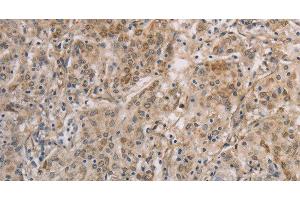 Immunohistochemistry of paraffin-embedded Human gastic cancer using ESRRG Polyclonal Antibody at dilution of 1:30 (ESRRG 抗体)