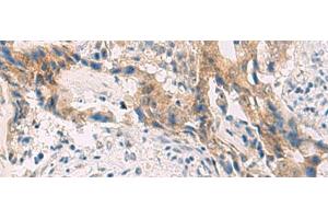Immunohistochemistry of paraffin-embedded Human cervical cancer tissue using PCYT2 Polyclonal Antibody at dilution of 1:55(x200) (PCYT2 抗体)