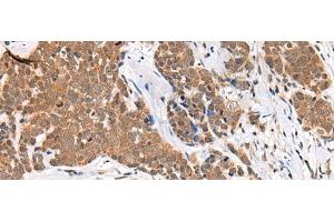 Immunohistochemistry of paraffin-embedded Human thyroid cancer tissue using CHAMP1 Polyclonal Antibody at dilution of 1:40(x200) (ZNF828 抗体)
