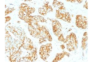 Formalin-fixed, paraffin-embedded human Prostate Carcinoma stained with CD44 Mouse Monoclonal Antibody (CD44v9/1459). (CD44 抗体)
