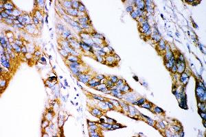 Anti- Claudin 2 antibody, IHC(P) IHC(P): Human Intestinal Cancer Tissue (Claudin 2 抗体  (AA 38-230))