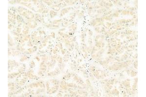 ABIN6265702 and ABIN6268943 at 1/100 staining human colon carcinoma by IHC-P.